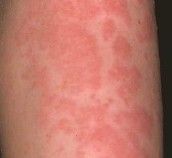 687_urticaria.jpg